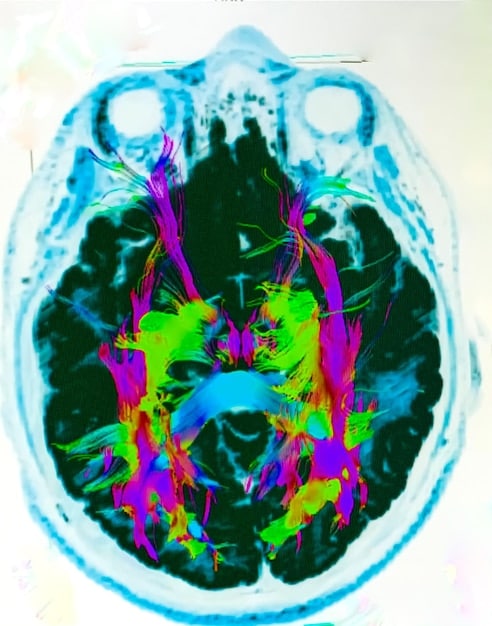 Brain scan images showing areas of activation during mindfulness meditation, illustrating the neurological impact on pain perception and emotional regulation.